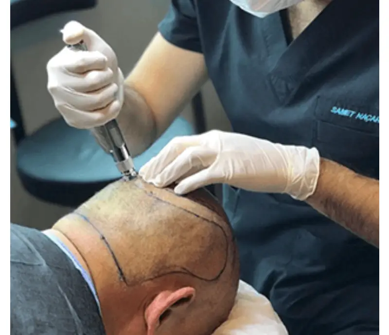Hair Transplant In Istanbul