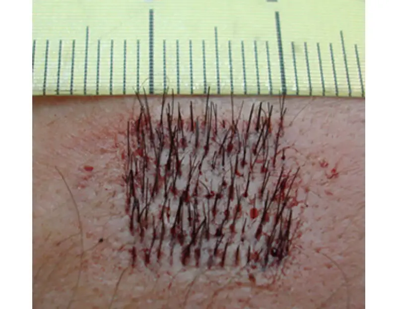 Hair Transplant In Turkey