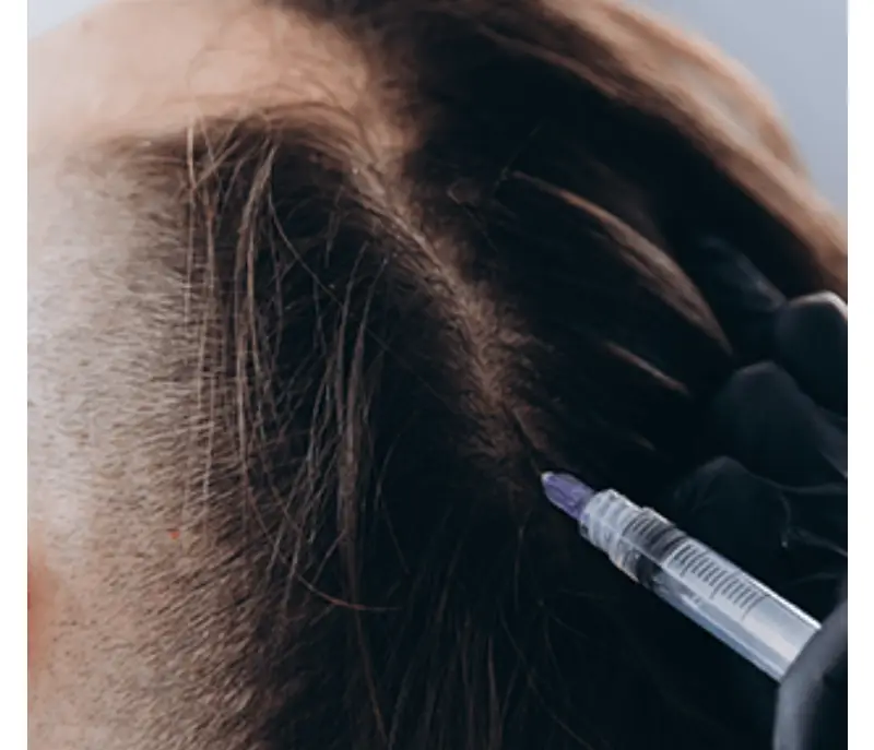 Mesotherapy In Istanbul
