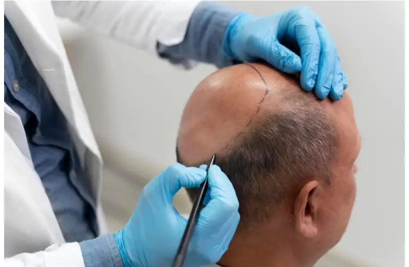 FUE Hair Transplant In Istanbul 