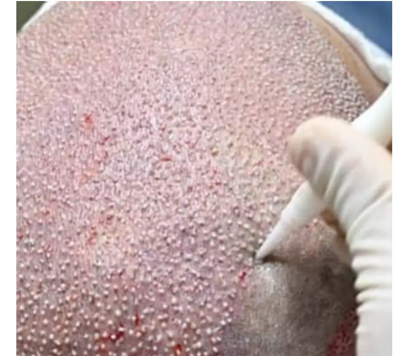 Hair Transplant in Turkey