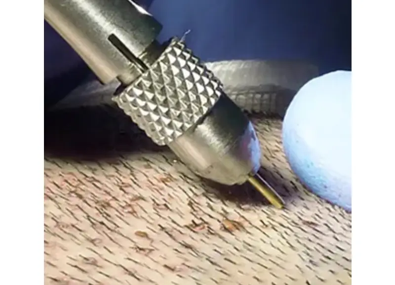FUE hair transplant in Istanbul.