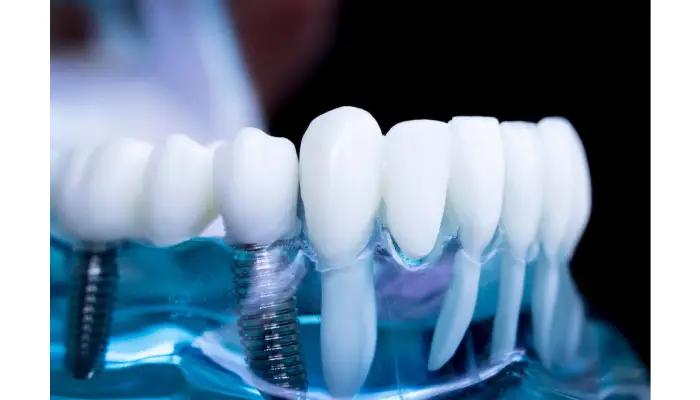 Dental team discussing All-on-X implant options with a patient in a modern clinic, promoting affordable dental solutions in Pembroke Pines