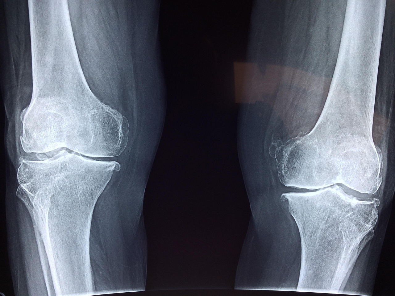 Discover Leading Orthopedic Specialist in Louisiana for Bone Health