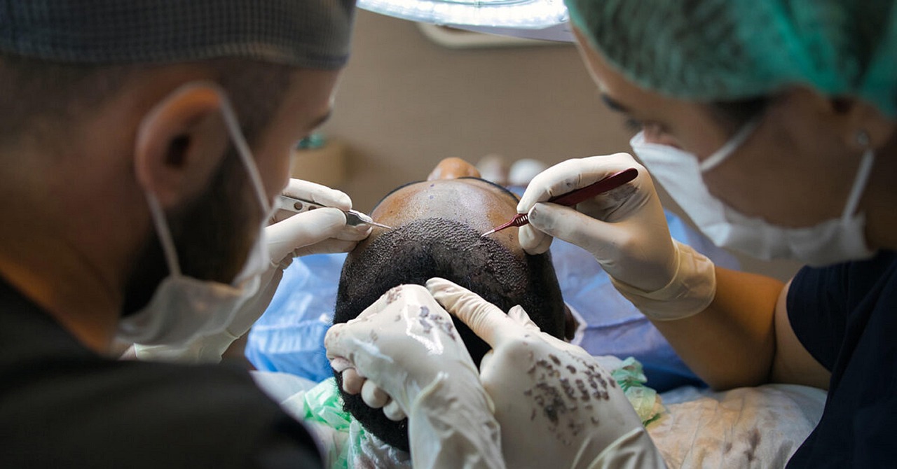 How FUE Hair Transplant Can Transform Your Hairline?
