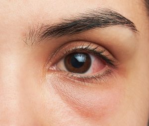 Treating Ocular Allergies