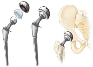 Hip Replacement Implant