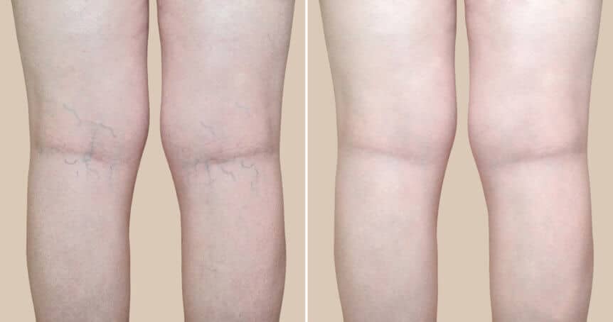 Vein Removal Treatment NY