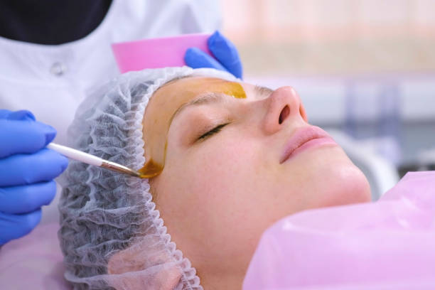 chemical peels