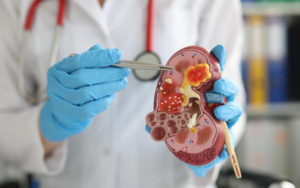 gall bladder stone treatment