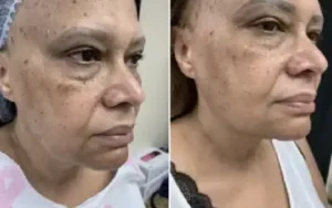 coolsculpting neck cost