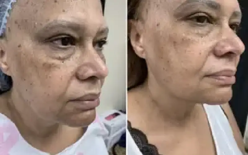 coolsculpting neck cost