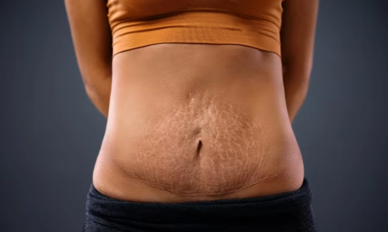 stretch mark microneedling