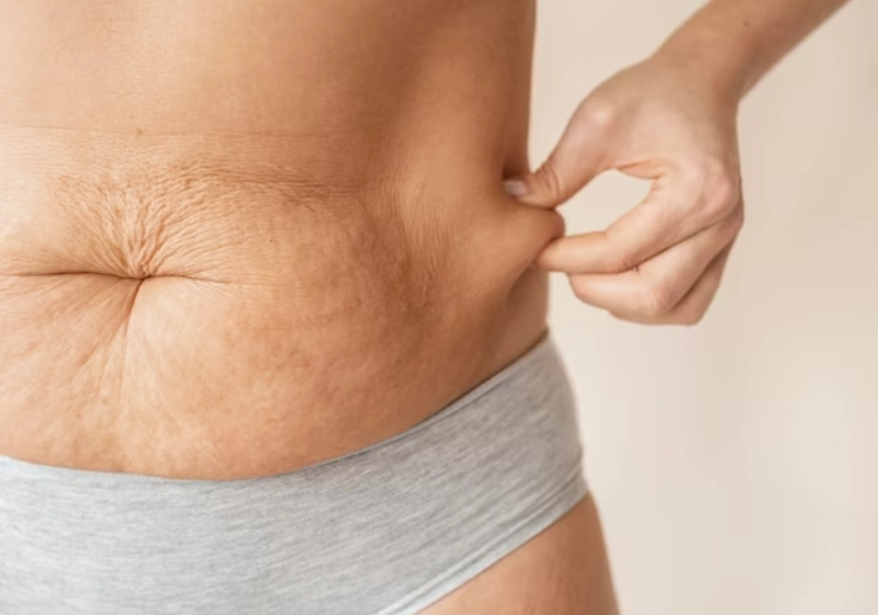 stretch mark microneedling