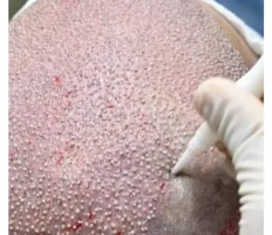 Hair Transplant In Istanbul