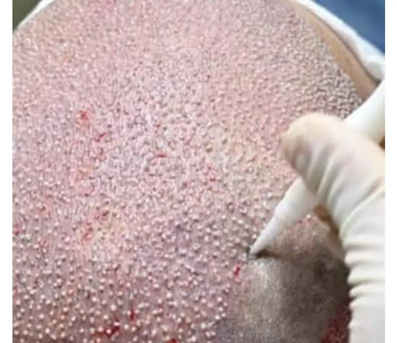 Hair Transplant In Istanbul