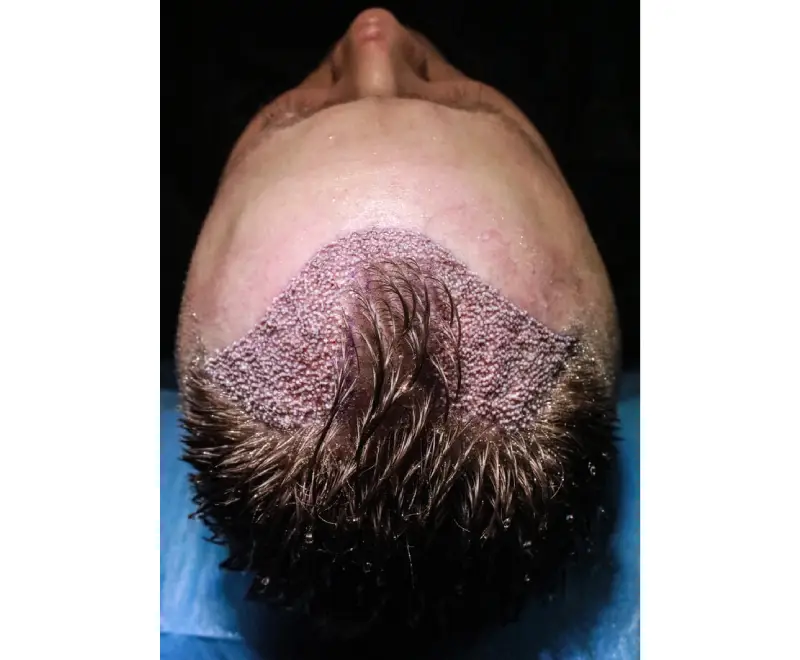 Hair Transplant In Turkey
