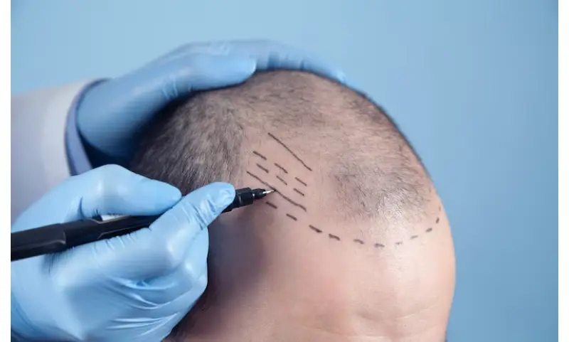 FUE Hair Transplant In Istanbul