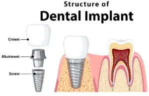 dental implants pembroke pines