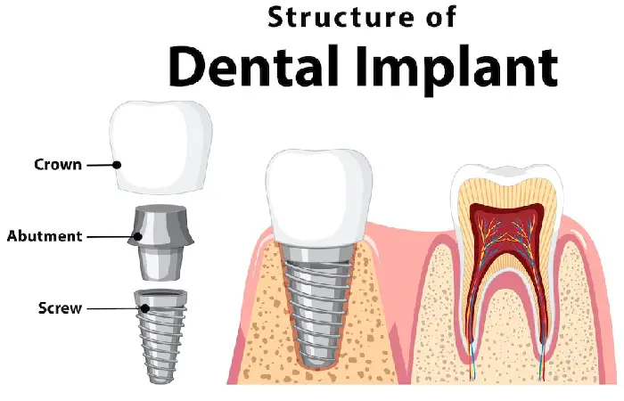 dental implants pembroke pines