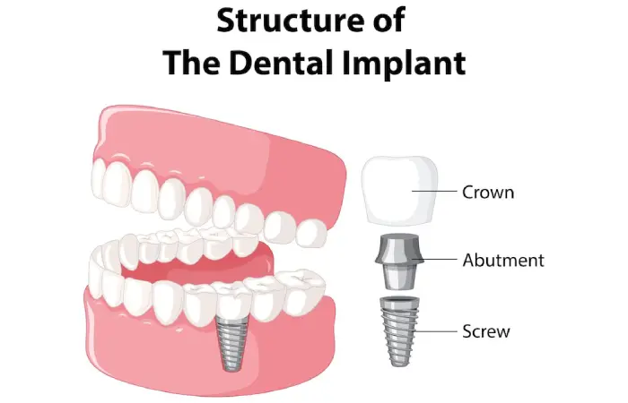 dental implants pembroke pines

