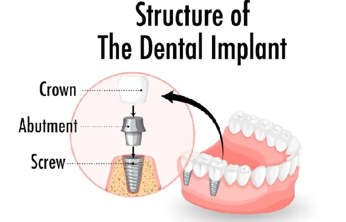 dental implants pembroke pines
