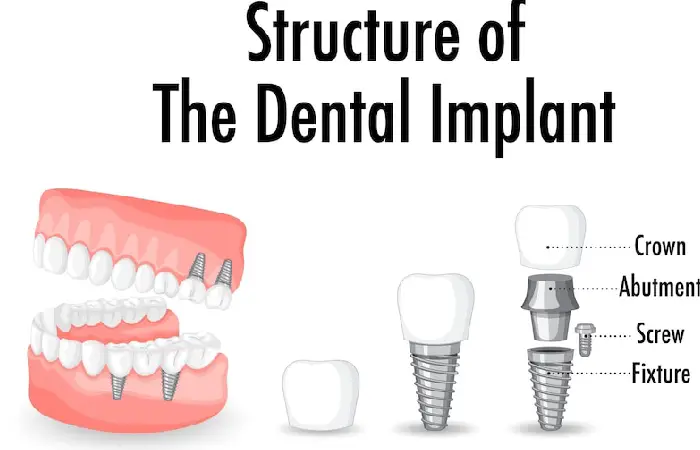 dental implants pembroke pines
