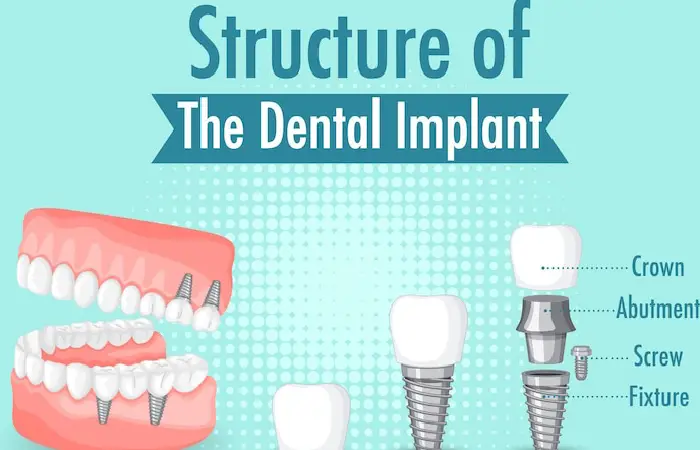 dental implants pembroke pines