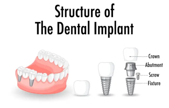 dental implants pembroke pines
