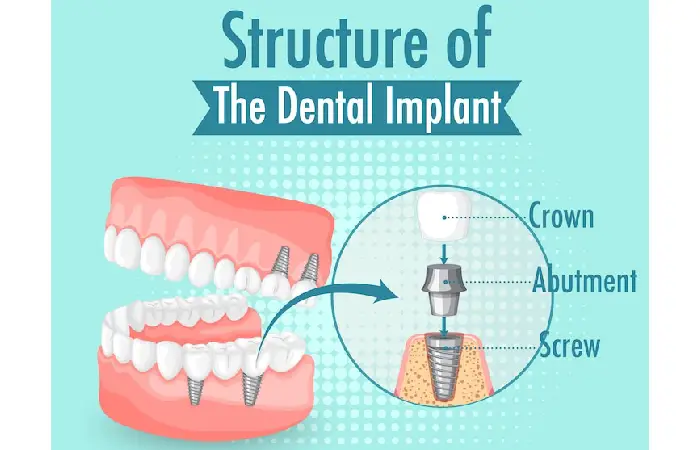 dental implants pembroke pines
