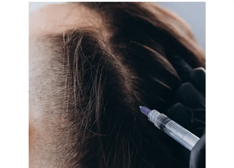 Mesotherapy in  istanbul