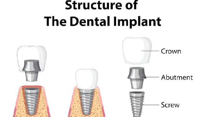 all-on-x dental implants pembroke pines