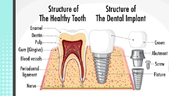 all-on-x dental implants pembroke pines