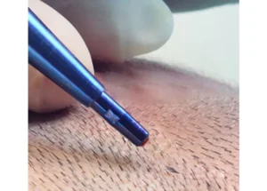 FUE hair transplant in Istanbul.